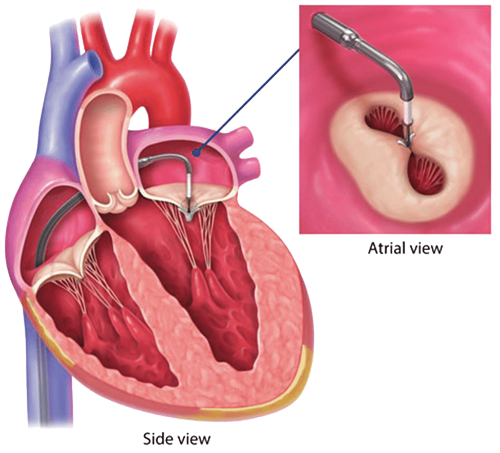 Mitral valve repair (percutaneous with mitraclip)