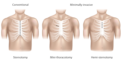 Surgical aortic valve replacement (minimally invasive)